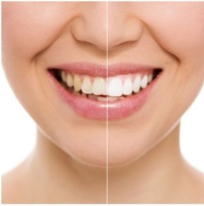 Dental Tooth Bonding  Cosmetic Dentist Orange Woodbridge Milford